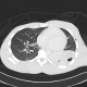 Lung contusion, hemothorax, pneumothorax, chest tube: CT - Computed tomography